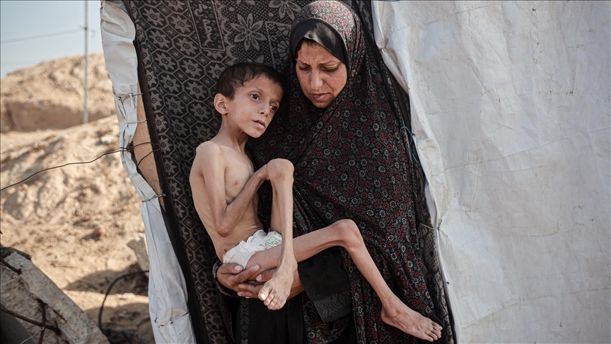 الأمم المتحدة تعلن ارتفاع عدد حالات سوء التغذية الحاد بغزة إلى 95 ألف حالة